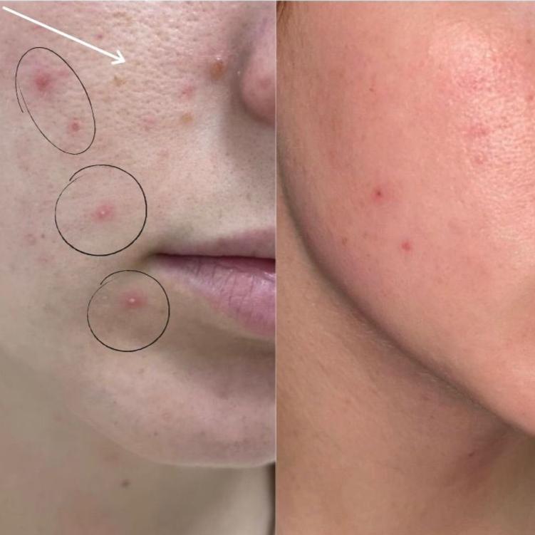 CLEAR - DAFNA'S clarifying facial serum for acne North Glow