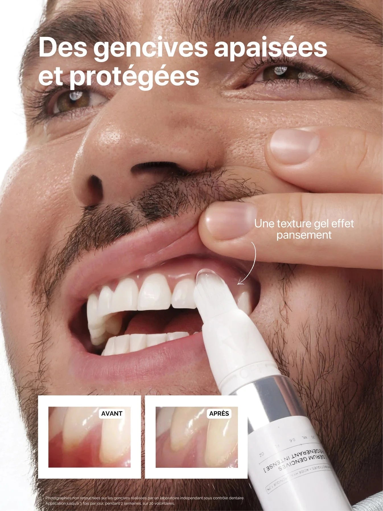 SoftTouch-Applikator mit Nanoborsten für präzises Auftragen auf empfindliches Zahnfleisch