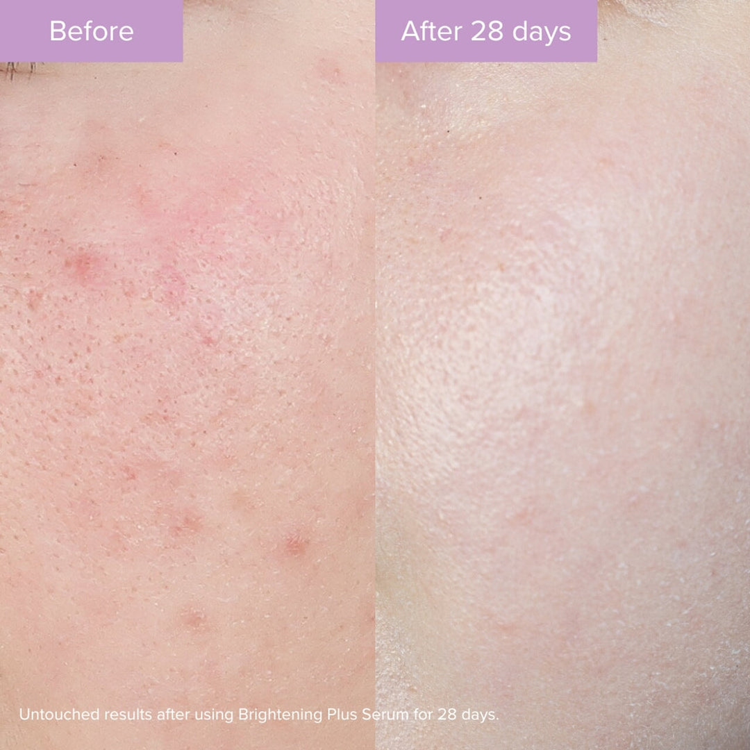Vorher-Nachher Anwendung des Brightening Plus Serums auf der Haut – für ein ebenmäßiges, gepflegtes Hautbild North Glow