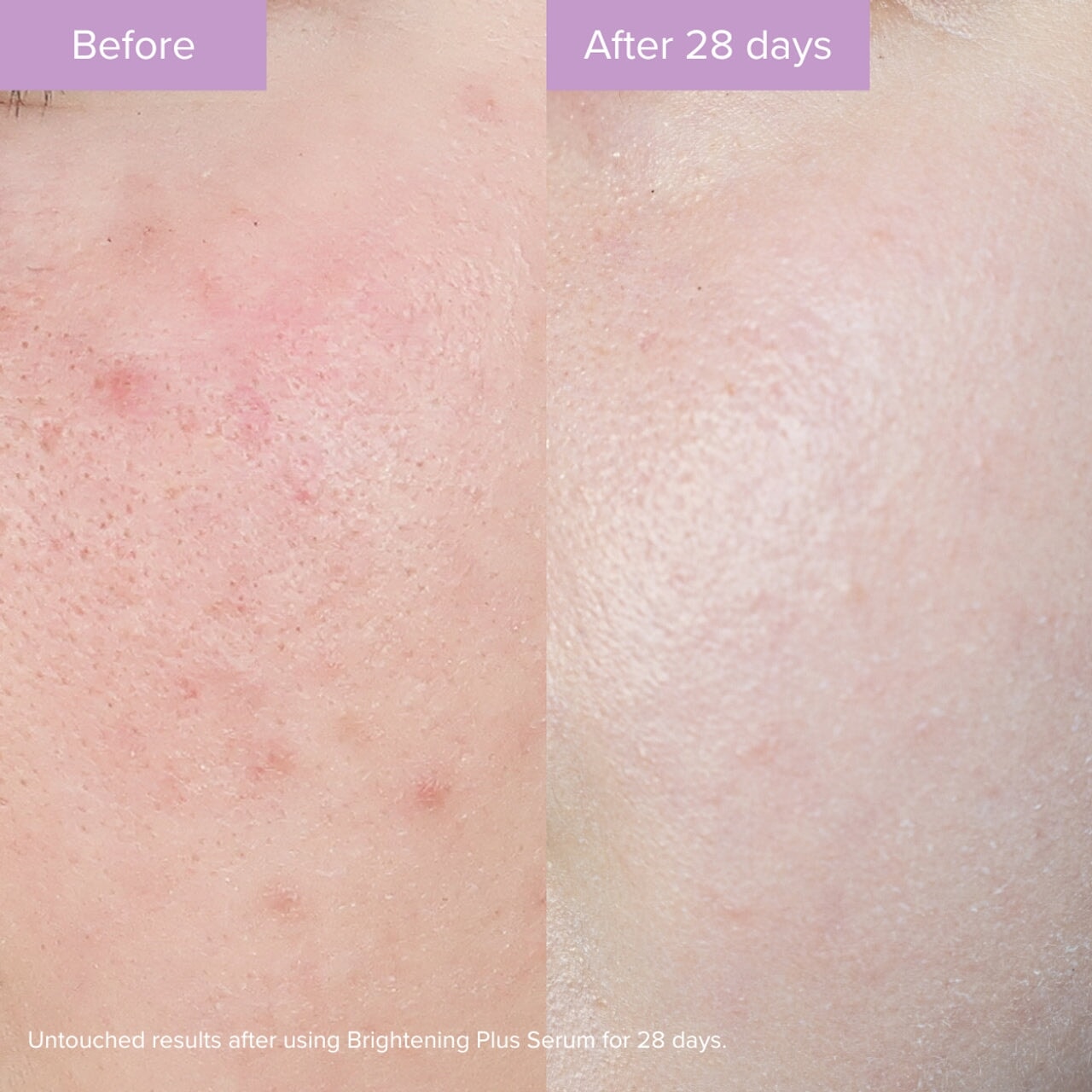 Vorher-Nachher Anwendung des Brightening Plus Serums auf der Haut – für ein ebenmäßiges, gepflegtes Hautbild