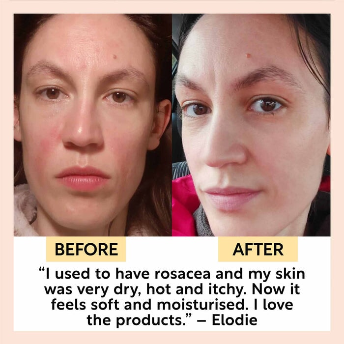 Vorher-Nachher-Bild einer Anwenderin mit Rosazea: Deutliche Reduktion der Hautrötungen und Verbesserung des Hautbildes nach Anwendung der UpCircle Cleansing Face Milk. North Glow
