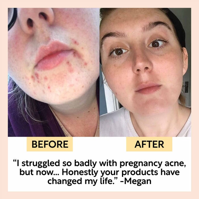 Vorher und Nachher Ergebnis der Nutzung des Upcircle Face Moisturisers